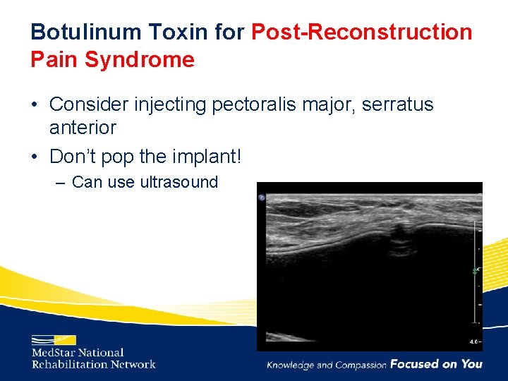 Botulinum Toxin for Post-Reconstruction Pain Syndrome • Consider injecting pectoralis major, serratus anterior •