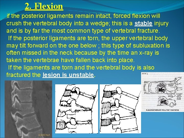 2. Flexion if the posterior ligaments remain intact, forced flexion will crush the vertebral