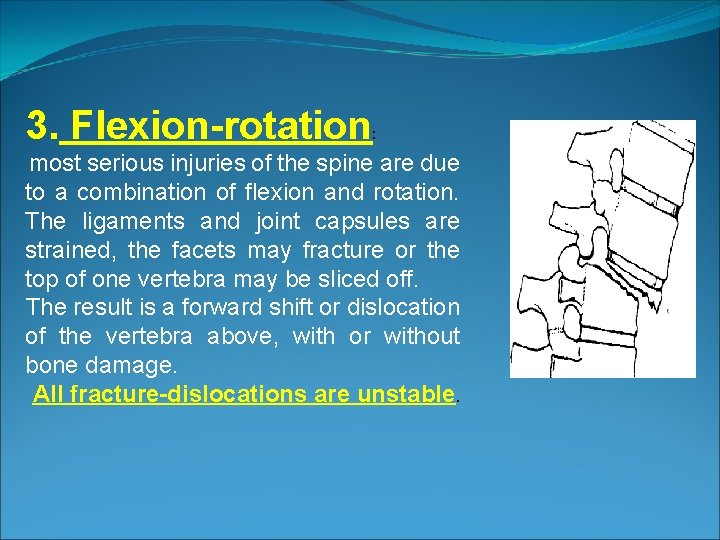 3. Flexion-rotation : most serious injuries of the spine are due to a combination