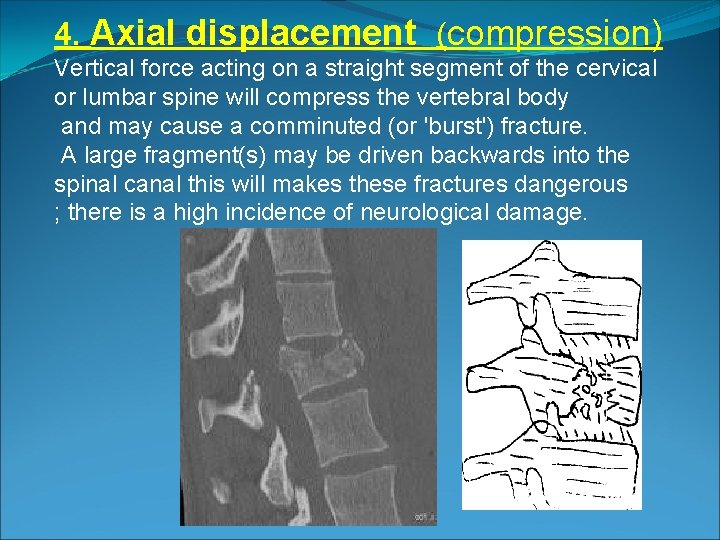 4. Axial displacement (compression) Vertical force acting on a straight segment of the cervical