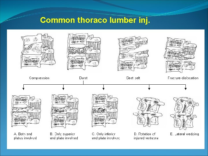 Common thoraco lumber inj. 