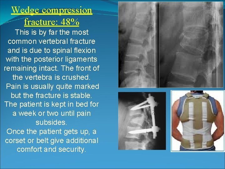 Wedge compression fracture: 48% This is by far the most common vertebral fracture and