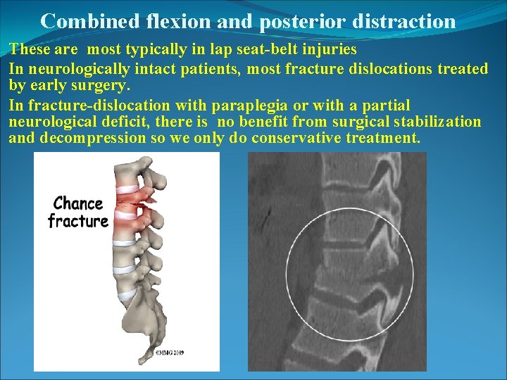Combined flexion and posterior distraction These are most typically in lap seat-belt injuries In