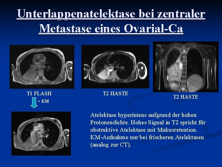 Unterlappenatelektase bei zentraler Metastase eines Ovarial-Ca T 1 FLASH + KM T 2 HASTE