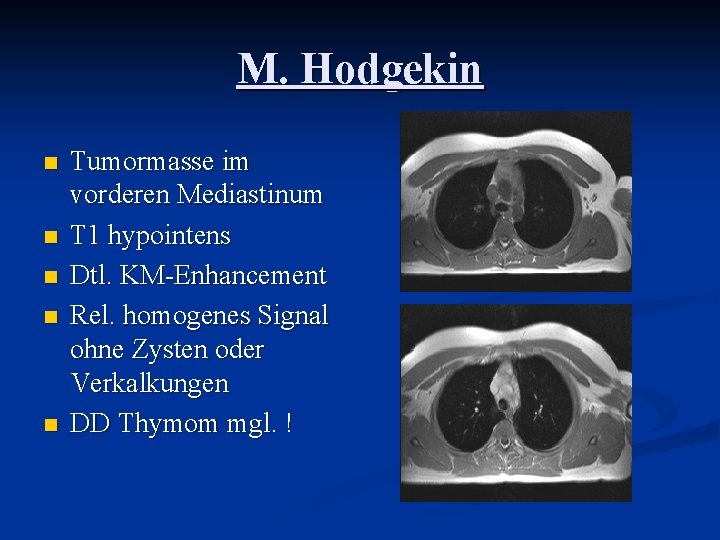 M. Hodgekin n n Tumormasse im vorderen Mediastinum T 1 hypointens Dtl. KM-Enhancement Rel.