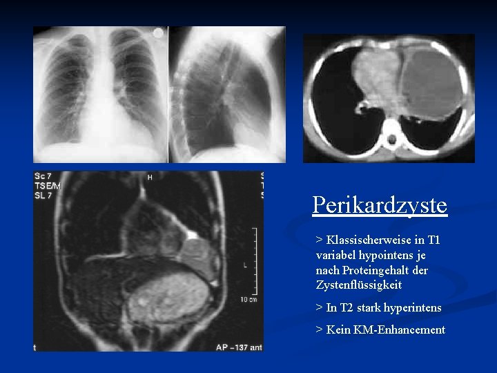 Perikardzyste > Klassischerweise in T 1 variabel hypointens je nach Proteingehalt der Zystenflüssigkeit >