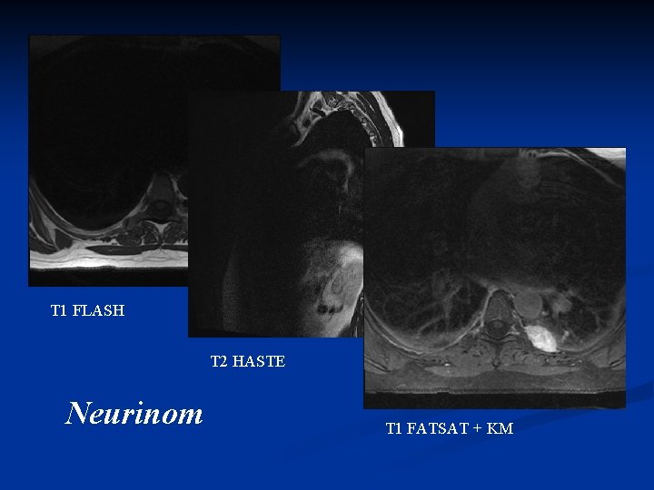 T 1 FLASH T 2 HASTE Neurinom T 1 FATSAT + KM 
