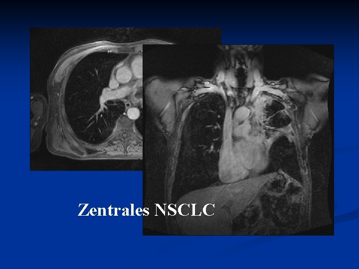  Zentrales NSCLC 