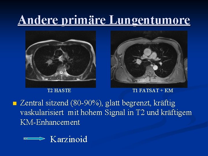 Andere primäre Lungentumore T 2 HASTE T 1 FATSAT + KM Zentral sitzend (80