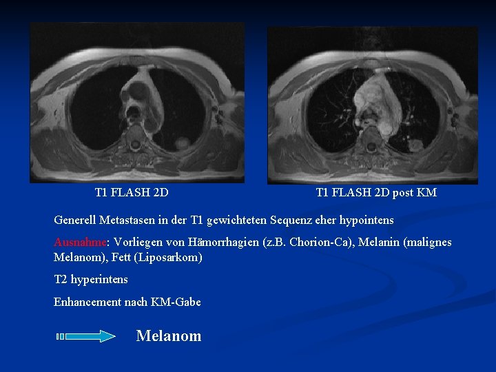 ct thorax mit km indikation
