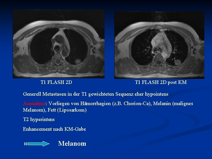  T 1 FLASH 2 D post KM Generell Metastasen in der T 1