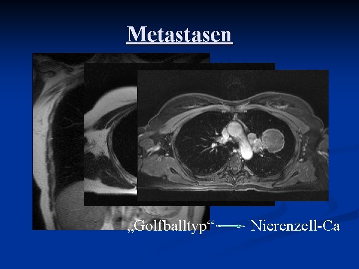 Metastasen „Golfballtyp“ Nierenzell-Ca 