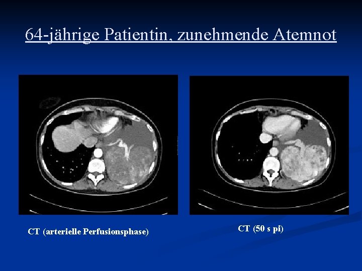64 -jährige Patientin, zunehmende Atemnot CT (arterielle Perfusionsphase) CT (50 s pi) 