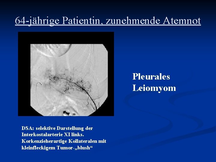 64 -jährige Patientin, zunehmende Atemnot Pleurales Leiomyom DSA: selektive Darstellung der Interkostalarterie XI links.
