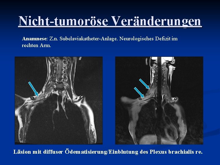 Nicht-tumoröse Veränderungen Anamnese: Z. n. Subclaviakatheter-Anlage. Neurologisches Defizit im rechten Arm. Läsion mit diffuser