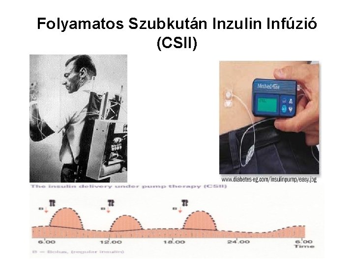Folyamatos Szubkután Inzulin Infúzió (CSII) 