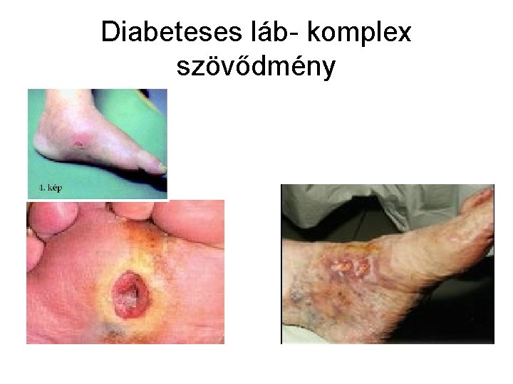 Diabeteses láb- komplex szövődmény 