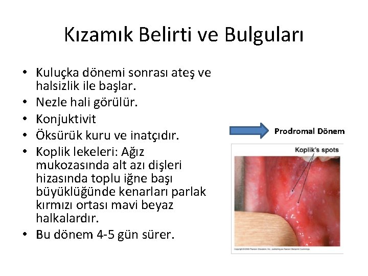 Kızamık Belirti ve Bulguları • Kuluçka dönemi sonrası ateş ve halsizlik ile başlar. •