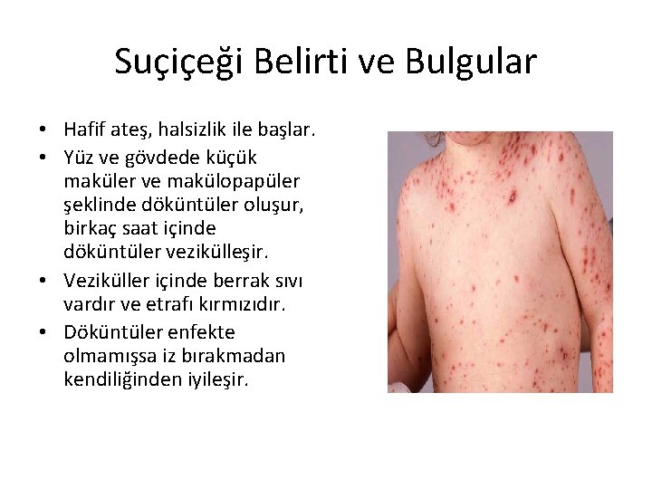 Suçiçeği Belirti ve Bulgular • Hafif ateş, halsizlik ile başlar. • Yüz ve gövdede