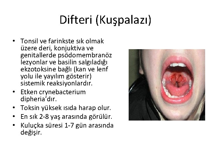 Difteri (Kuşpalazı) • Tonsil ve farinkste sık olmak üzere deri, konjuktiva ve genitallerde psödomembranöz