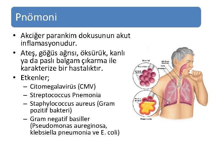 Pnömoni • Akciğer parankim dokusunun akut inflamasyonudur. • Ateş, göğüs ağrısı, öksürük, kanlı ya