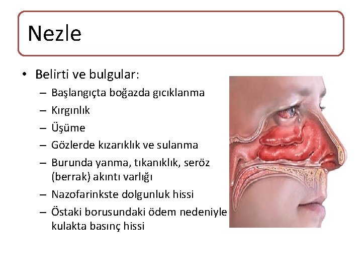 Nezle • Belirti ve bulgular: Başlangıçta boğazda gıcıklanma Kırgınlık Üşüme Gözlerde kızarıklık ve sulanma