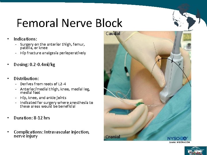 Femoral Nerve Block • Indications: Caudal - Surgery on the anterior thigh, femur, patella,