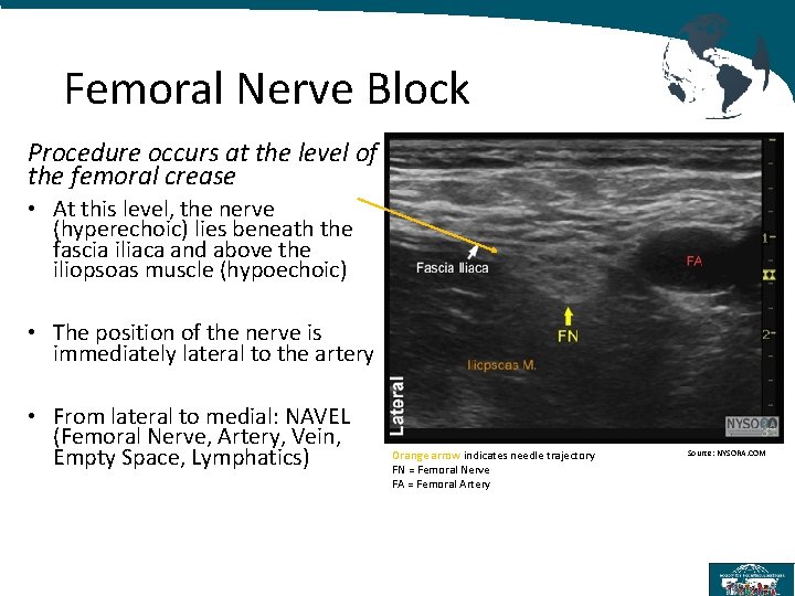 Femoral Nerve Block Procedure occurs at the level of the femoral crease • At