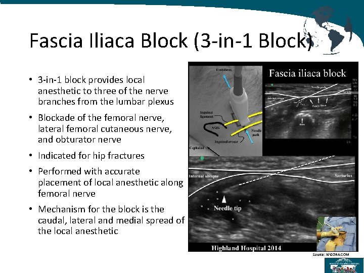 Fascia Iliaca Block (3 -in-1 Block) • 3 -in-1 block provides local anesthetic to