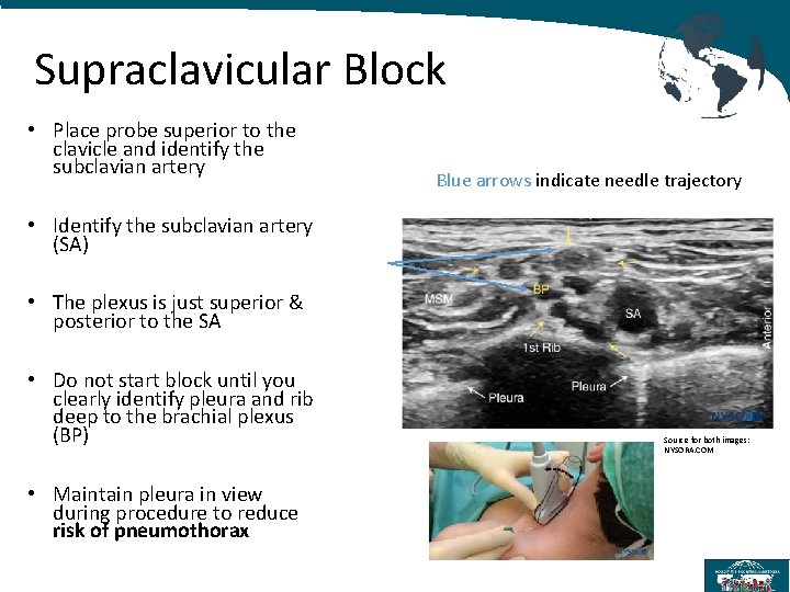 Supraclavicular Block • Place probe superior to the clavicle and identify the subclavian artery