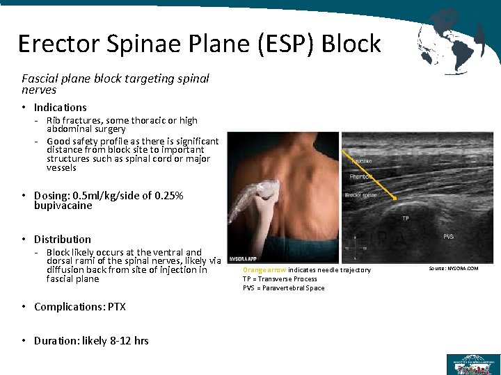 Erector Spinae Plane (ESP) Block Fascial plane block targeting spinal nerves • Indications -