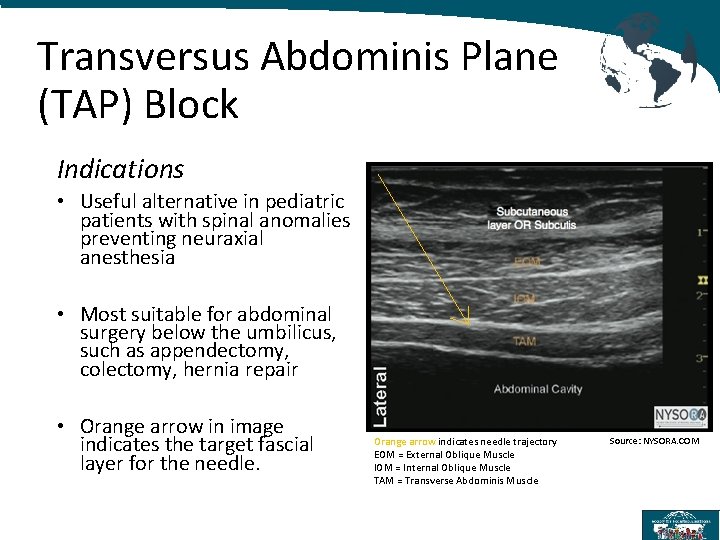 Transversus Abdominis Plane (TAP) Block Indications • Useful alternative in pediatric patients with spinal