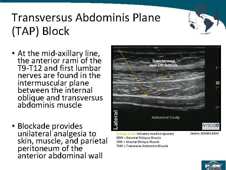 Transversus Abdominis Plane (TAP) Block • At the mid-axillary line, the anterior rami of