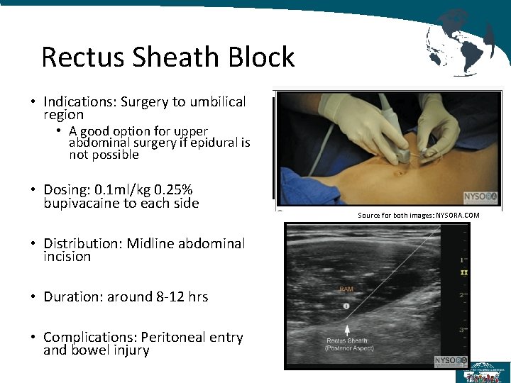 Rectus Sheath Block • Indications: Surgery to umbilical region • A good option for