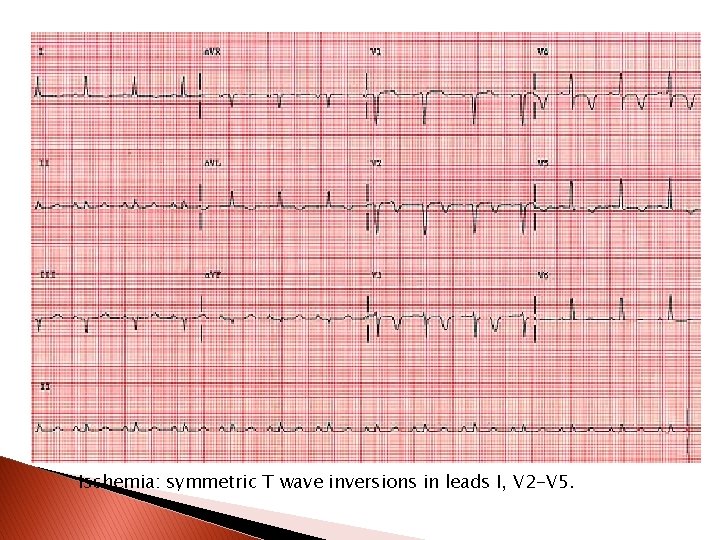 Ischemia: symmetric T wave inversions in leads I, V 2 -V 5. 