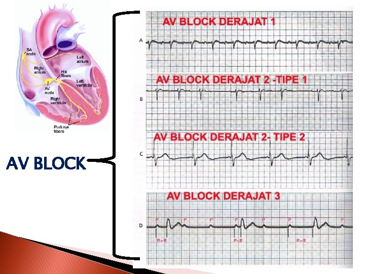 AV BLOCK 