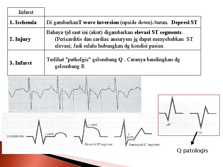 Infarct 1. Ischemia Di gambarkan. T wave inversion (upside down). /turun. Depresi ST 2.