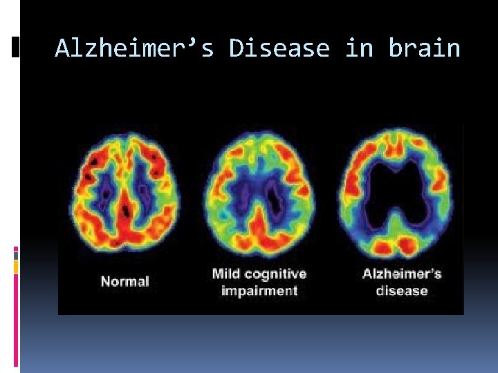 Alzheimer’s Disease in brain 