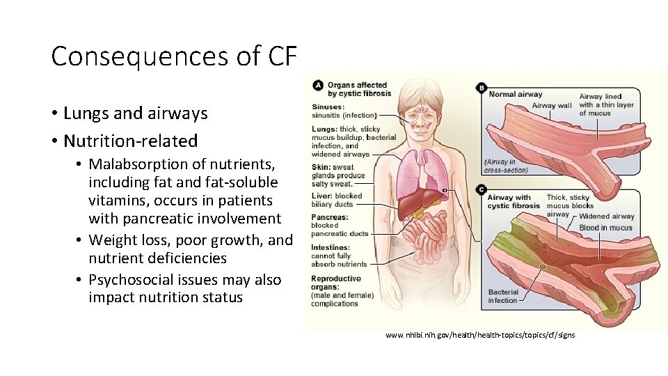 Consequences of CF • Lungs and airways • Nutrition-related • Malabsorption of nutrients, including