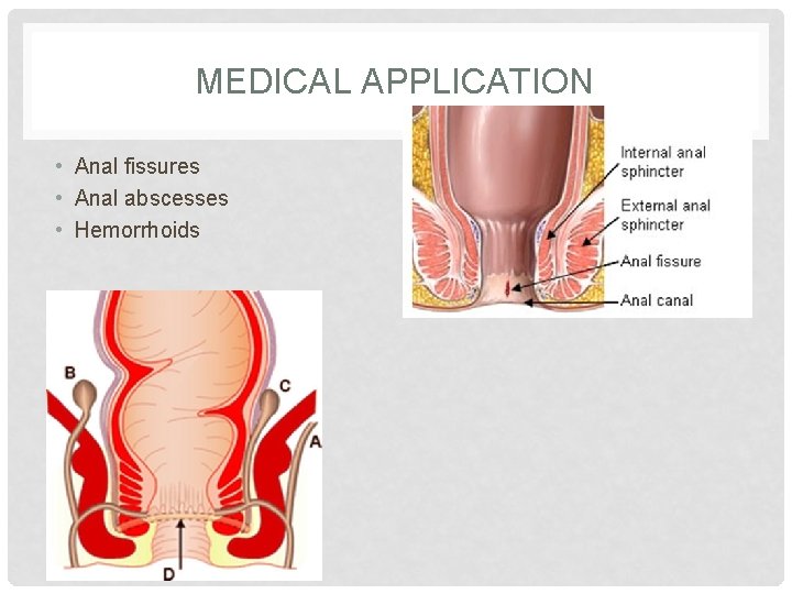 MEDICAL APPLICATION • Anal fissures • Anal abscesses • Hemorrhoids 