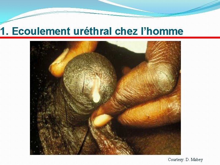 1. Ecoulement uréthral chez l’homme Courtesy: D. Mabey 
