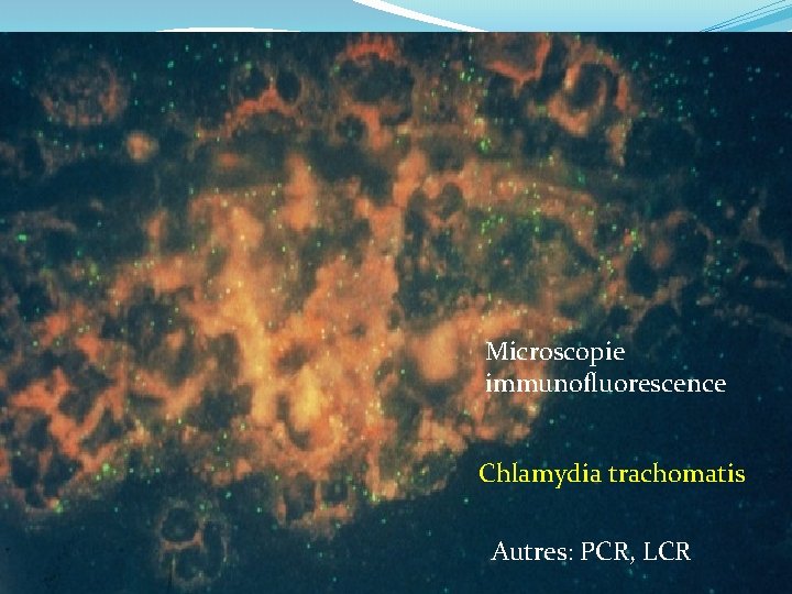 Microscopie immunofluorescence Chlamydia trachomatis Autres: PCR, LCR 