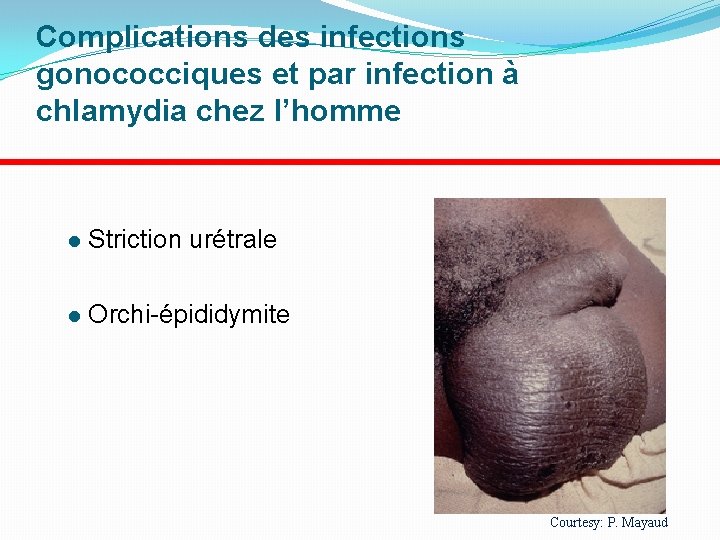 Complications des infections gonococciques et par infection à chlamydia chez l’homme Striction urétrale Orchi-épididymite