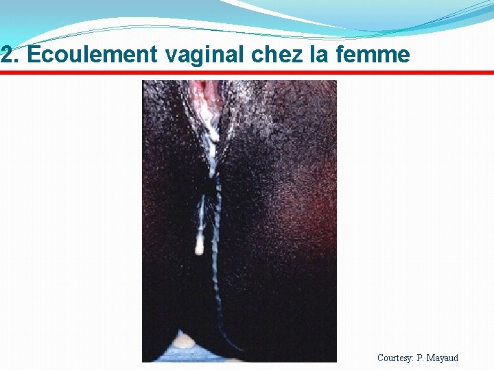 2. Ecoulement vaginal chez la femme Courtesy: P. Mayaud 