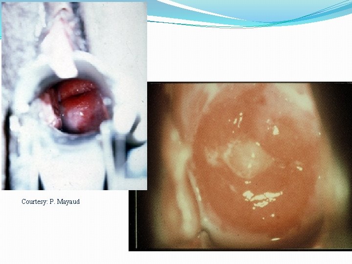 Courtesy: P. Mayaud 