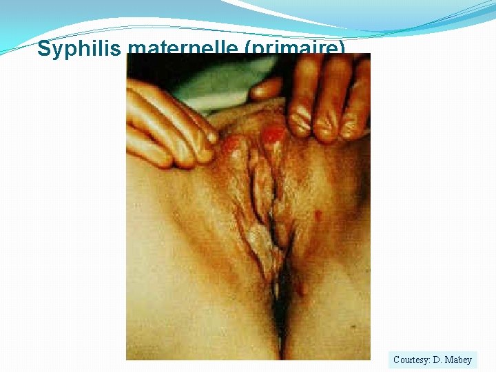 Syphilis maternelle (primaire) Courtesy: D. Mabey 