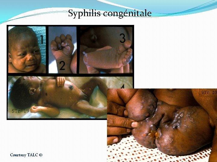 Syphilis congénitale Courtesy TALC © 