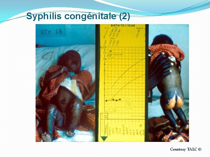 Syphilis congénitale (2) Courtesy TALC © 