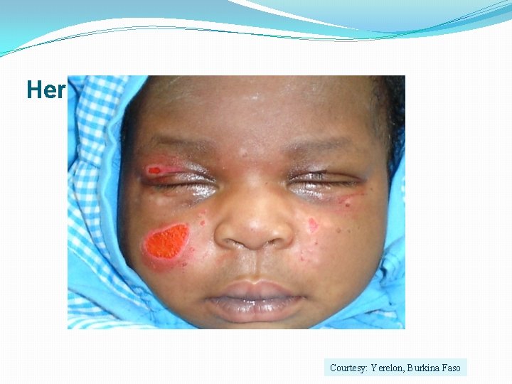 Herpès congénital Courtesy: Yerelon, Burkina Faso 