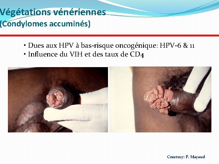 Végétations vénériennes (Condylomes accuminés) • Dues aux HPV à bas-risque oncogénique: HPV-6 & 11